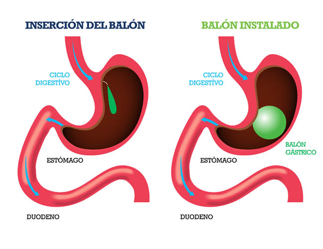 Balón Intragástrico - CirugíaBariatrica - IMOBariatrica