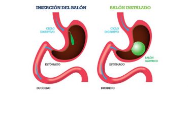 Balón-Intragástrico-CirugíaBariatrica-IMOBariatrica (Grande)