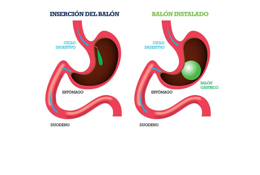 Balón-Intragástrico-CirugíaBariatrica-IMOBariatrica (Grande)