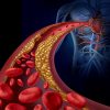 Las dislipidemias-arterias-IMOBariatrica (media)