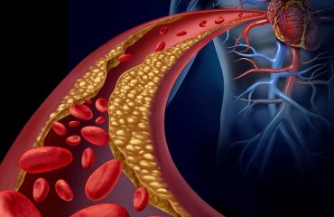 Las dislipidemias-arterias-IMOBariatrica (media)
