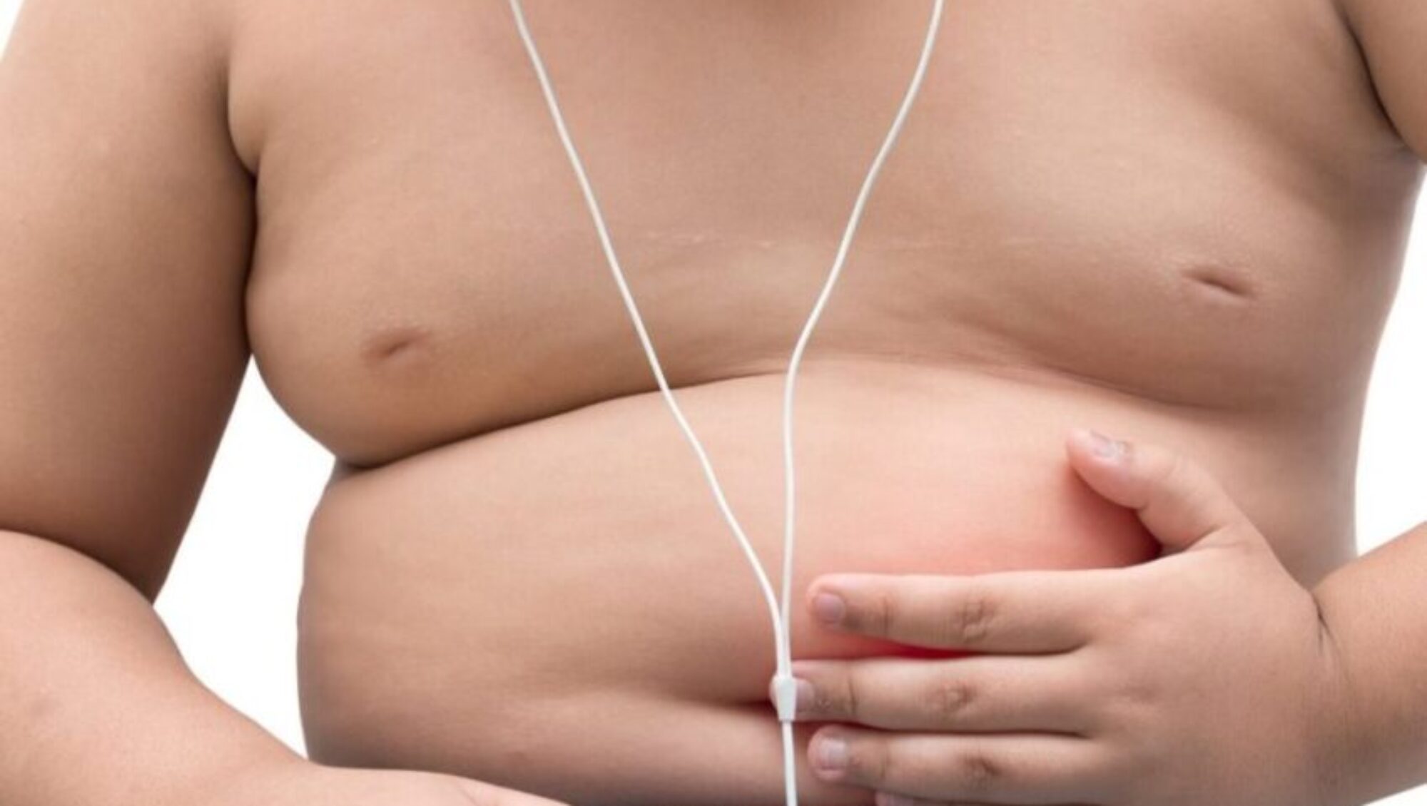 Reflujo gastroesofágico relación con el sobrepeso imobariatrica